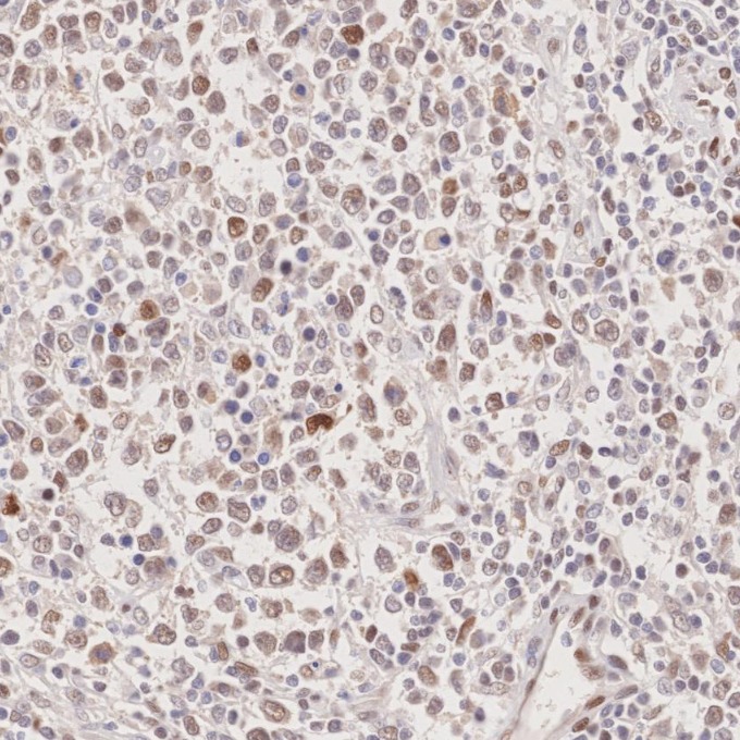 IHC staining of human lymphoma using 60283-2-Ig