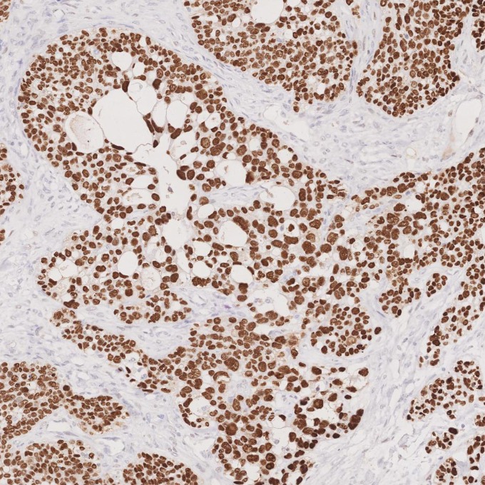 IHC staining of human ovary cancer using 60283-2-Ig