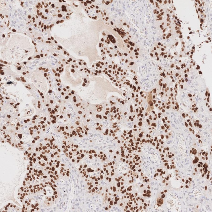 IHC staining of human ovary cancer using 60283-2-Ig