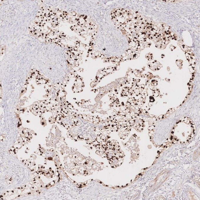 IHC staining of human ovary cancer using 60283-2-Ig