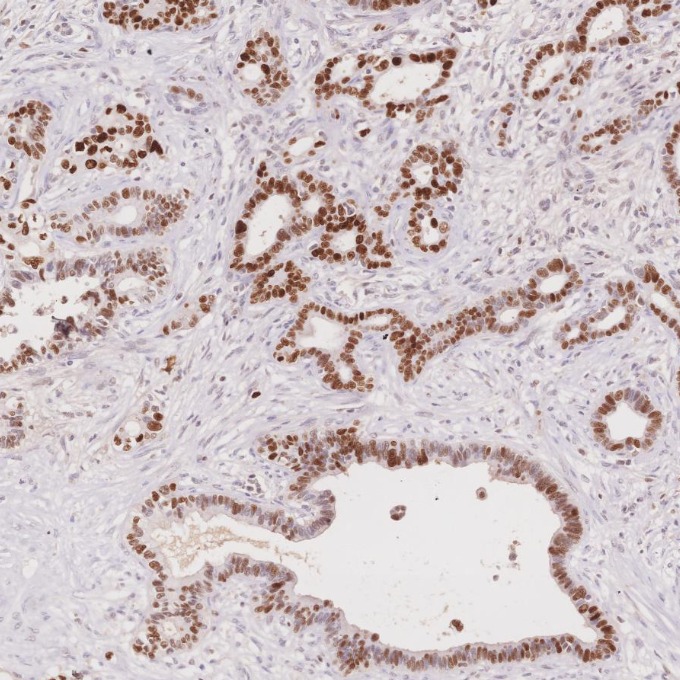 IHC staining of human pancreas cancer using 60283-2-Ig