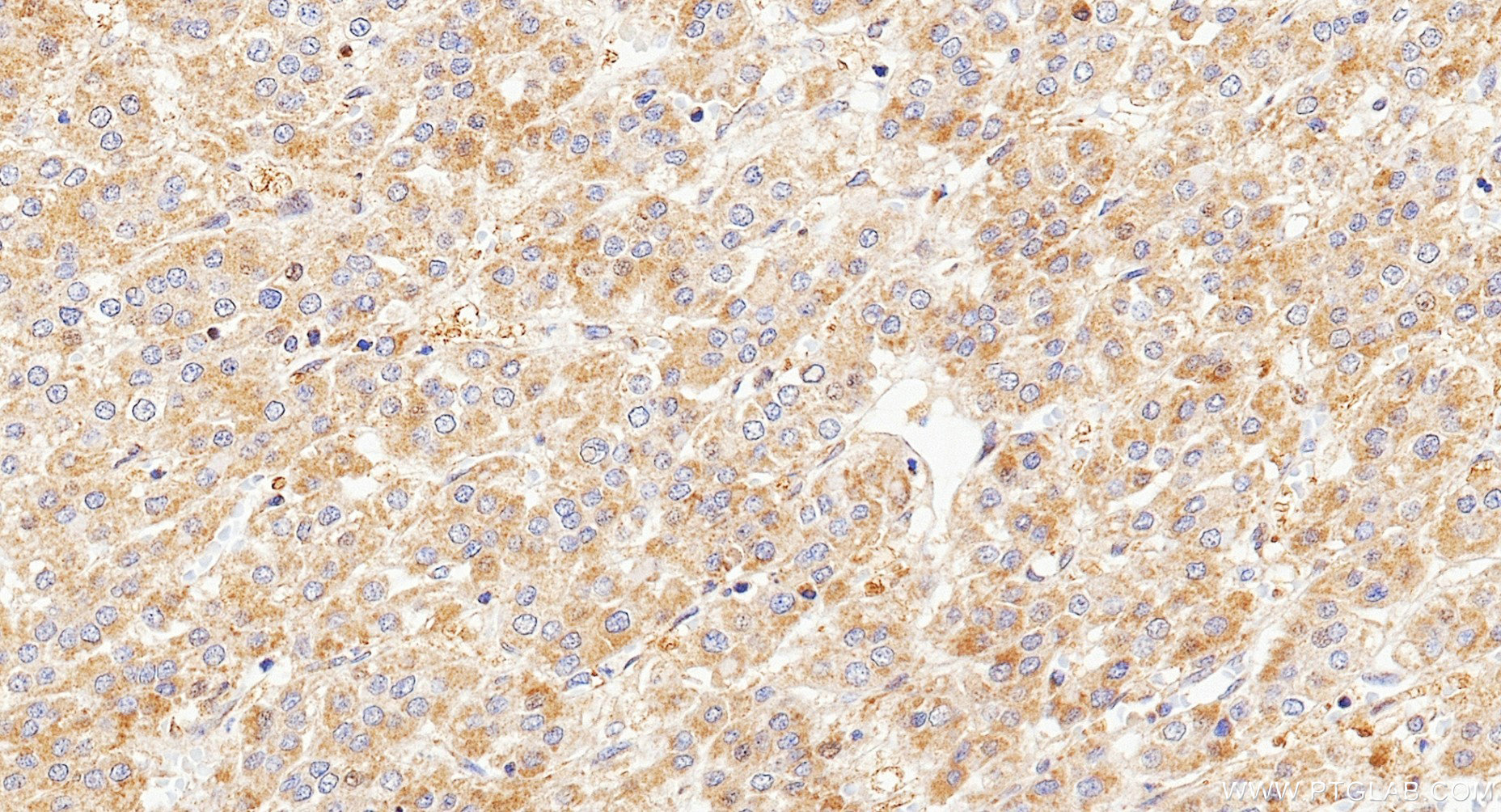 IHC staining of Human Hepatocellular cancer using 87037-1-RR (same clone as 87037-1-PBS) IHC staining of Human Hepatocellular cancer using 87037-1-RR (same clone as 87037-1-PBS)
