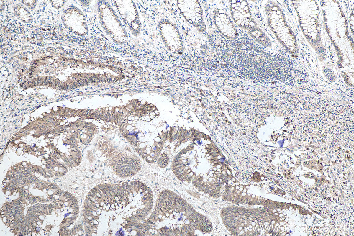IHC staining of human colon cancer using 66184-1-Ig