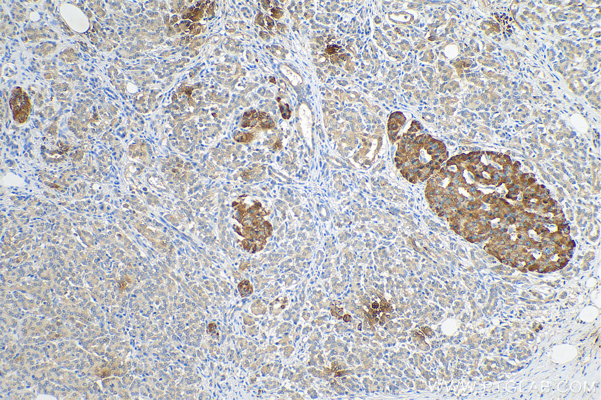 IHC staining of human pancreas cancer using 80294-1-RR