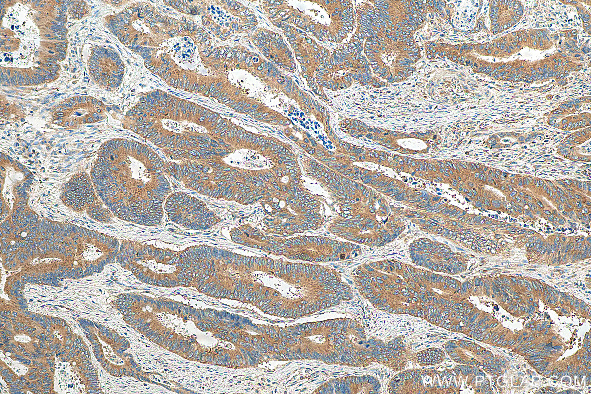 IHC staining of human colon cancer using 68187-1-Ig