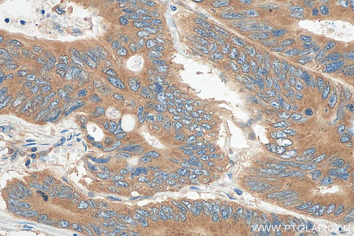 IHC staining of human colon cancer using 68187-1-Ig