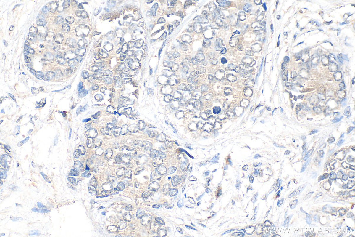 IHC staining of human prostate cancer using 12110-1-AP