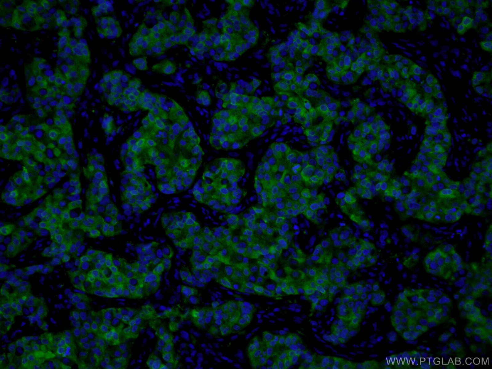 IF Staining of human breast cancer using 66386-1-Ig