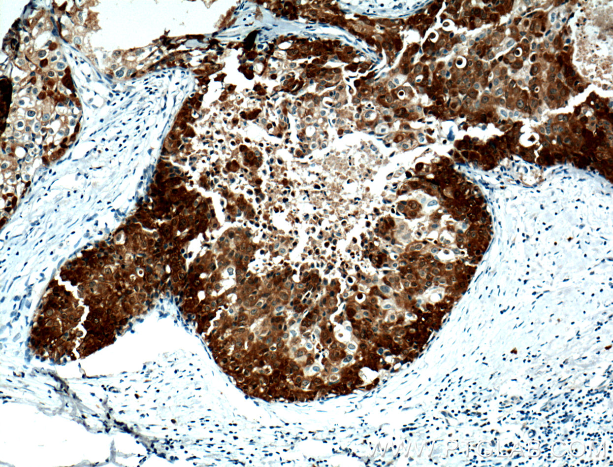 IHC staining of human breast cancer using 66386-1-Ig