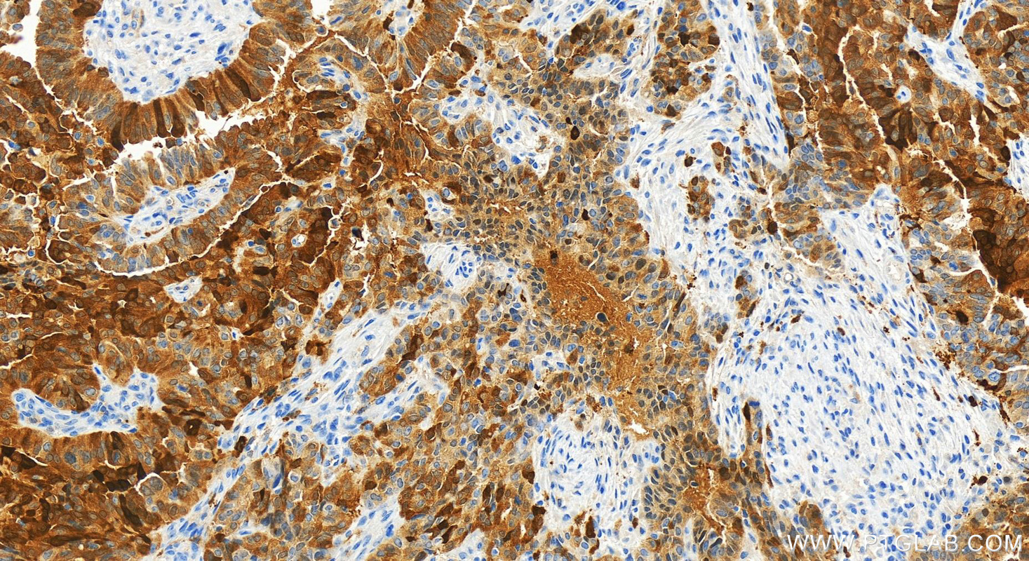 IHC staining of human ovarian  cancer using 83868-1-RR