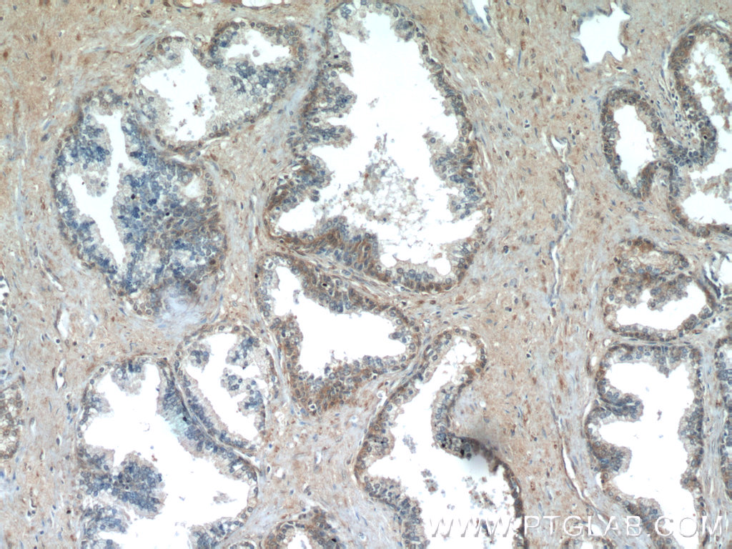 IHC staining of human prostate hyperplasia using 11961-1-AP