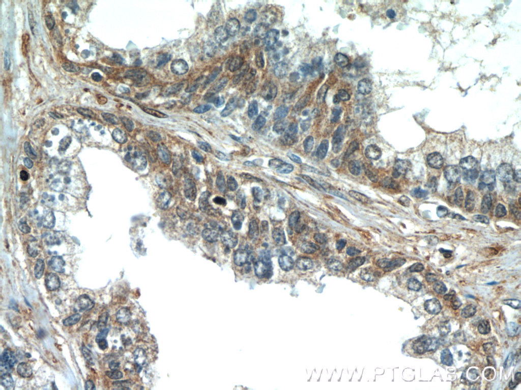 IHC staining of human prostate hyperplasia using 11961-1-AP