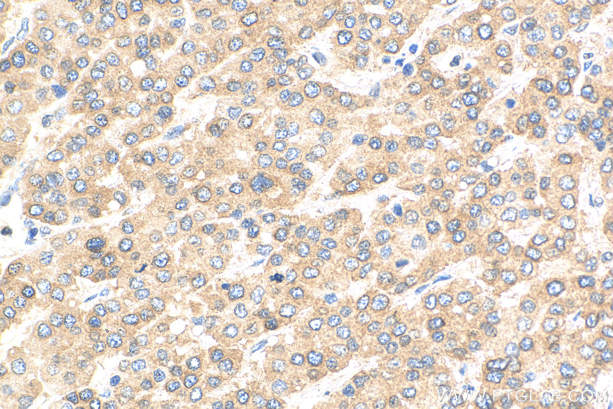 IHC staining of human liver cancer using 68042-1-Ig