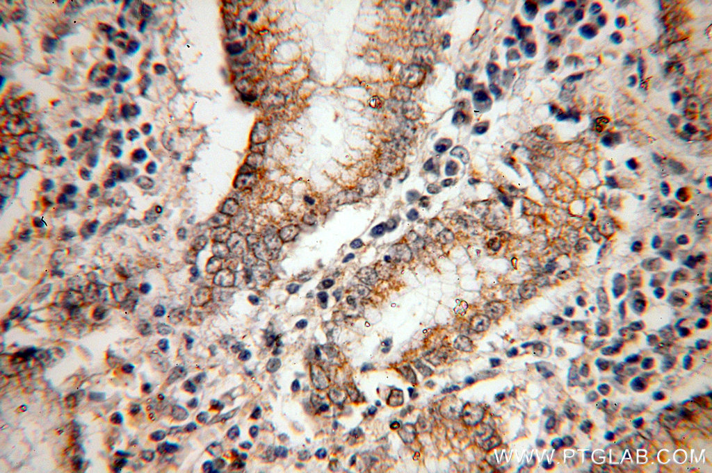 IHC staining of human stomach cancer using 51137-1-AP