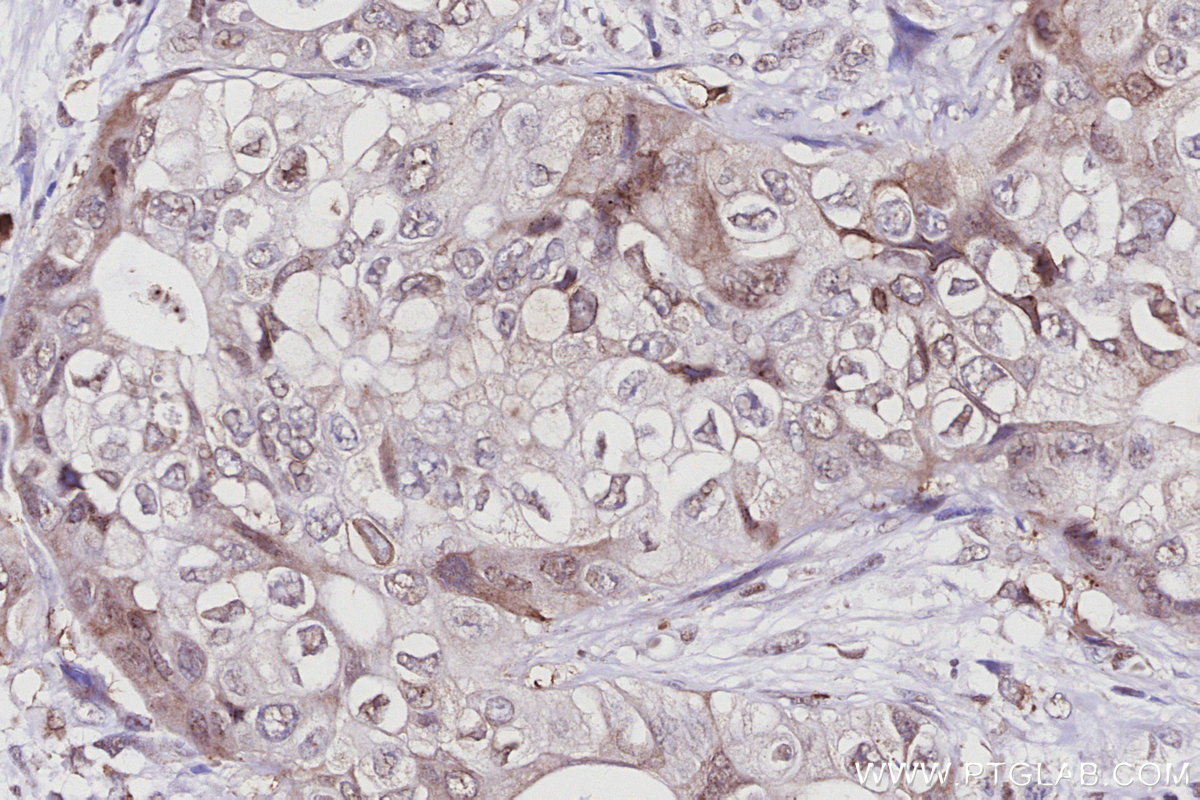 IHC staining of human pancreas cancer using 67562-1-Ig IHC staining of human pancreas cancer using 67562-1-Ig