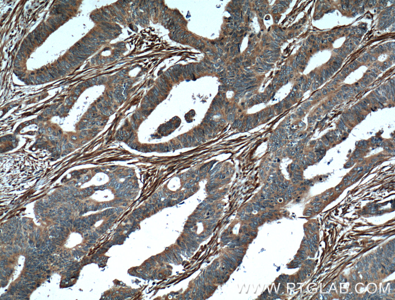 IHC staining of human colon cancer using 10853-1-AP
