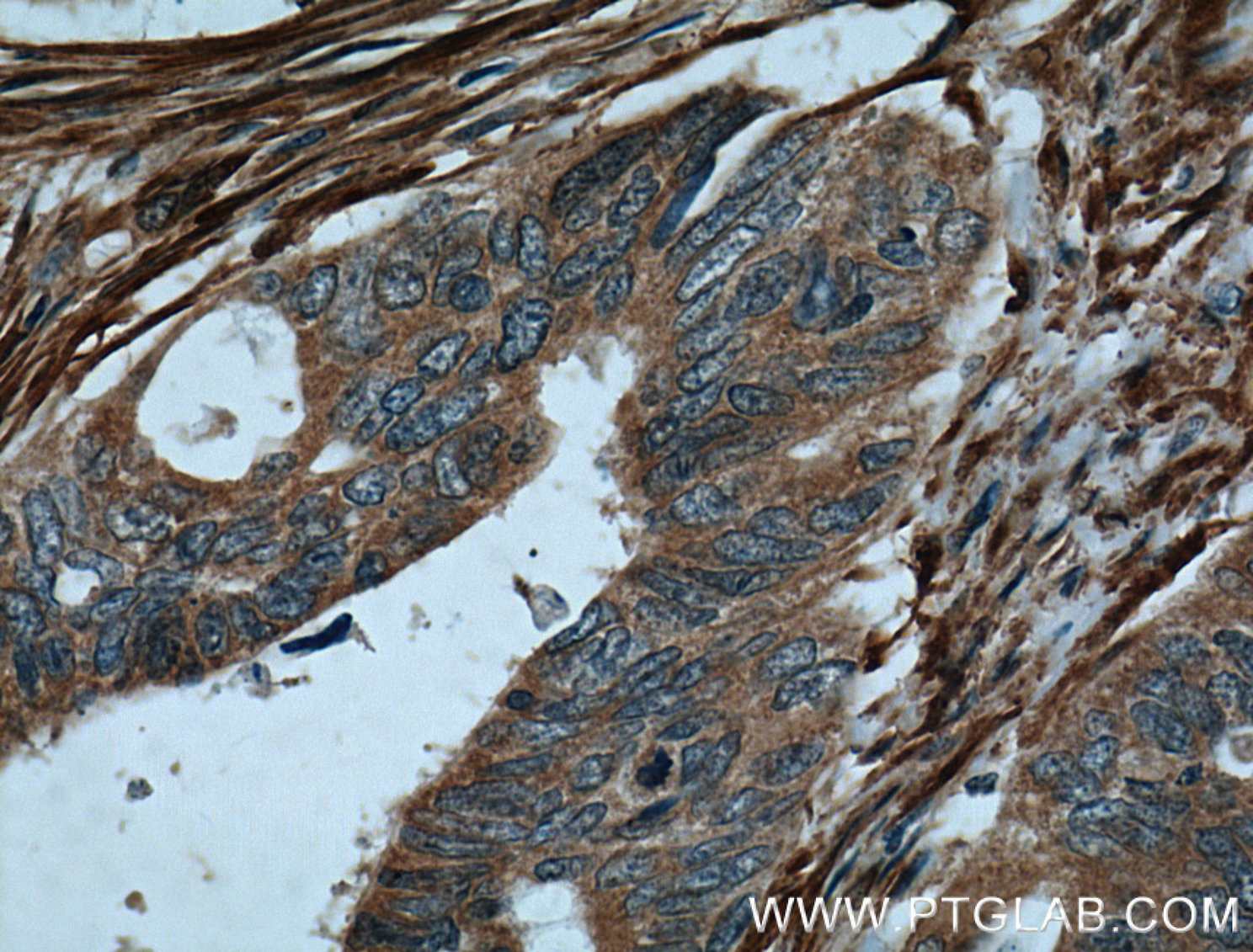 IHC staining of human colon cancer using 10853-1-AP