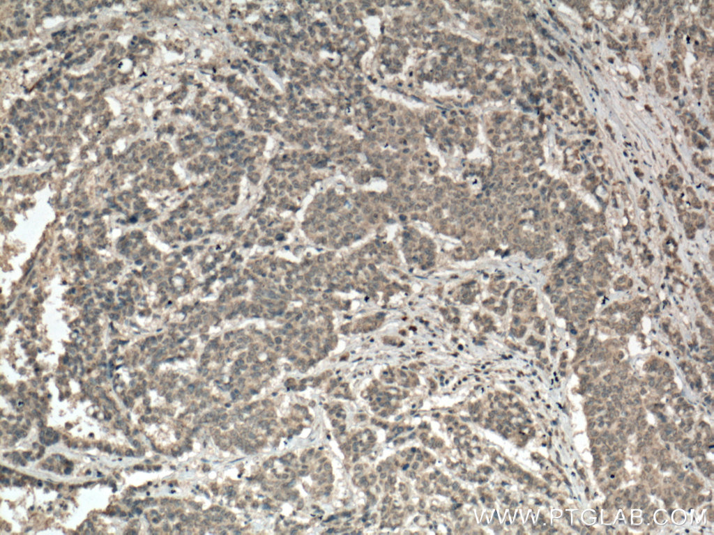 IHC staining of human colon cancer using 66601-1-Ig (same clone as 66601-1-PBS)