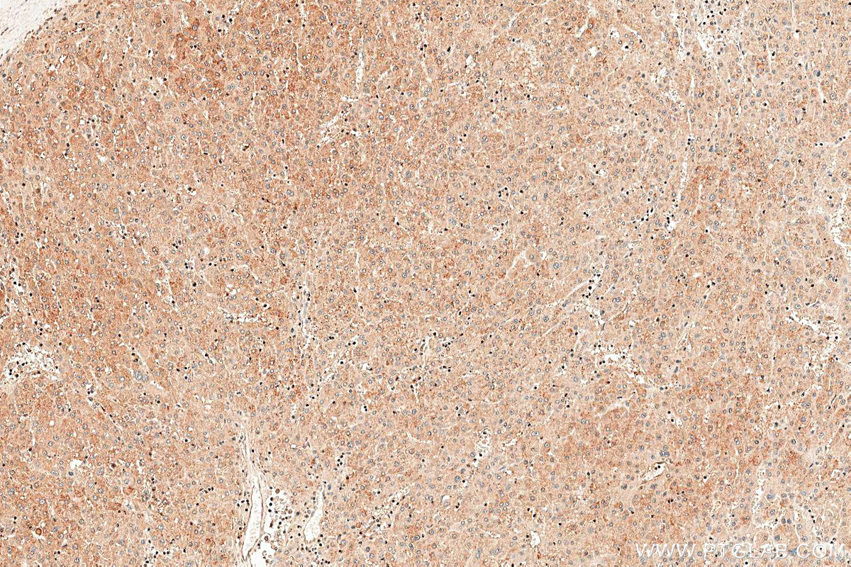 IHC staining of human liver cancer using 16531-1-AP