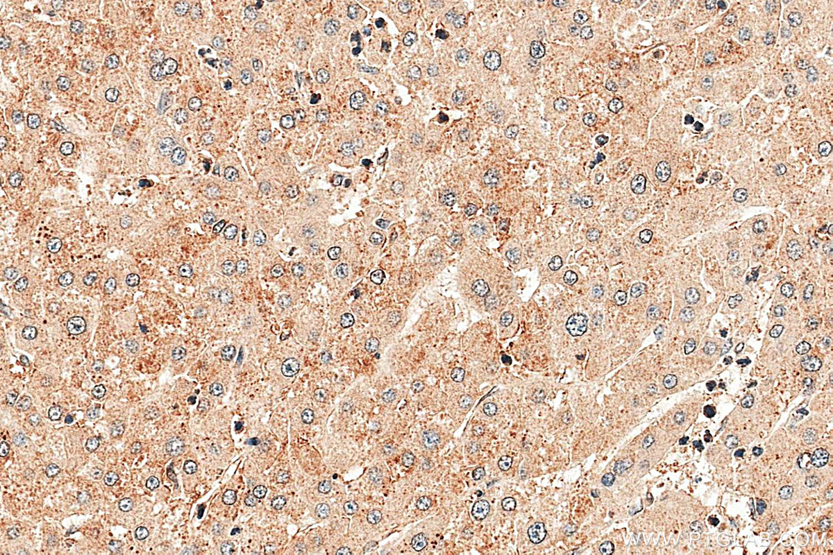IHC staining of human liver cancer using 16531-1-AP