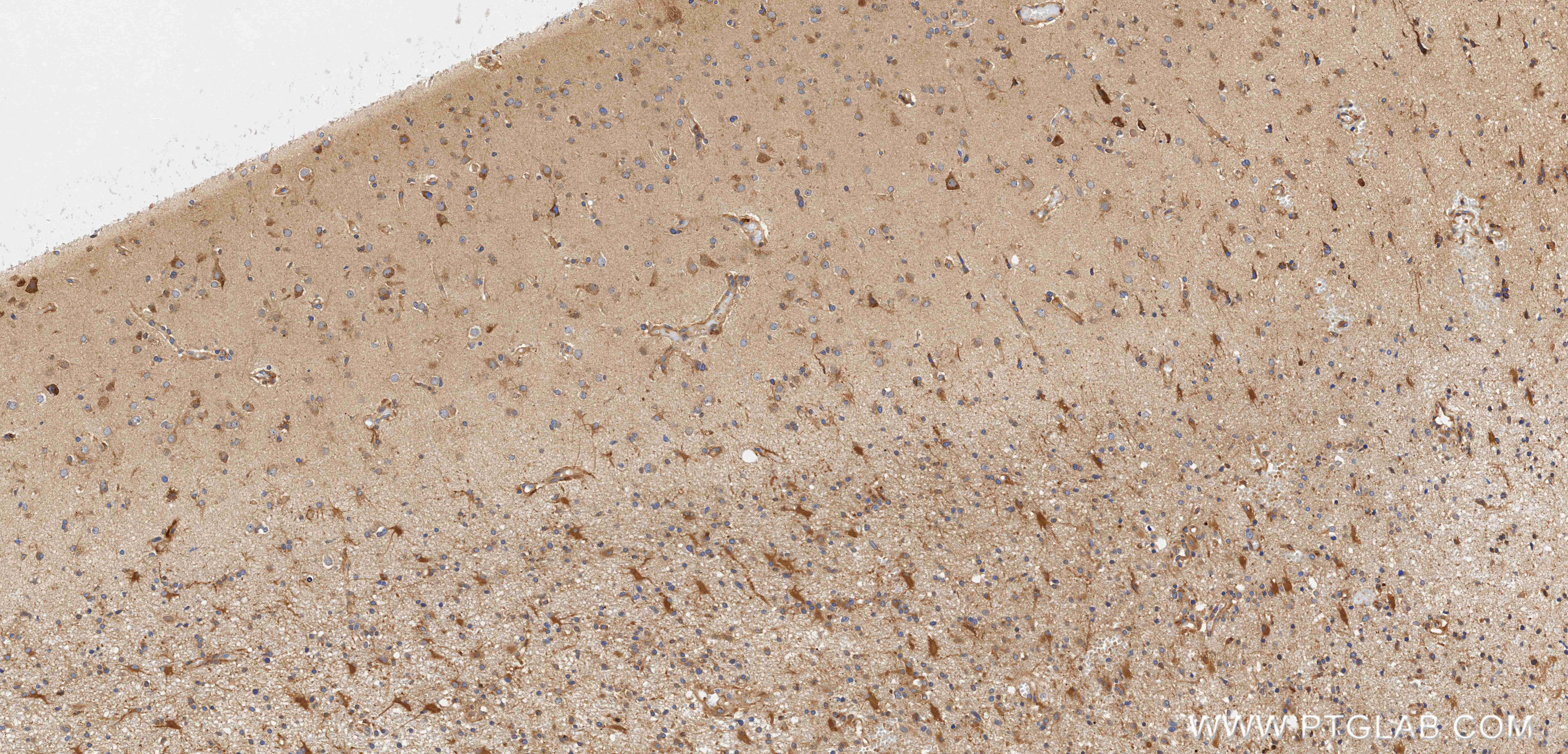 IHC staining of Human brain cancer（Astrocitoma） using 98696-1-RR (same clone as 98696-1-PBS)