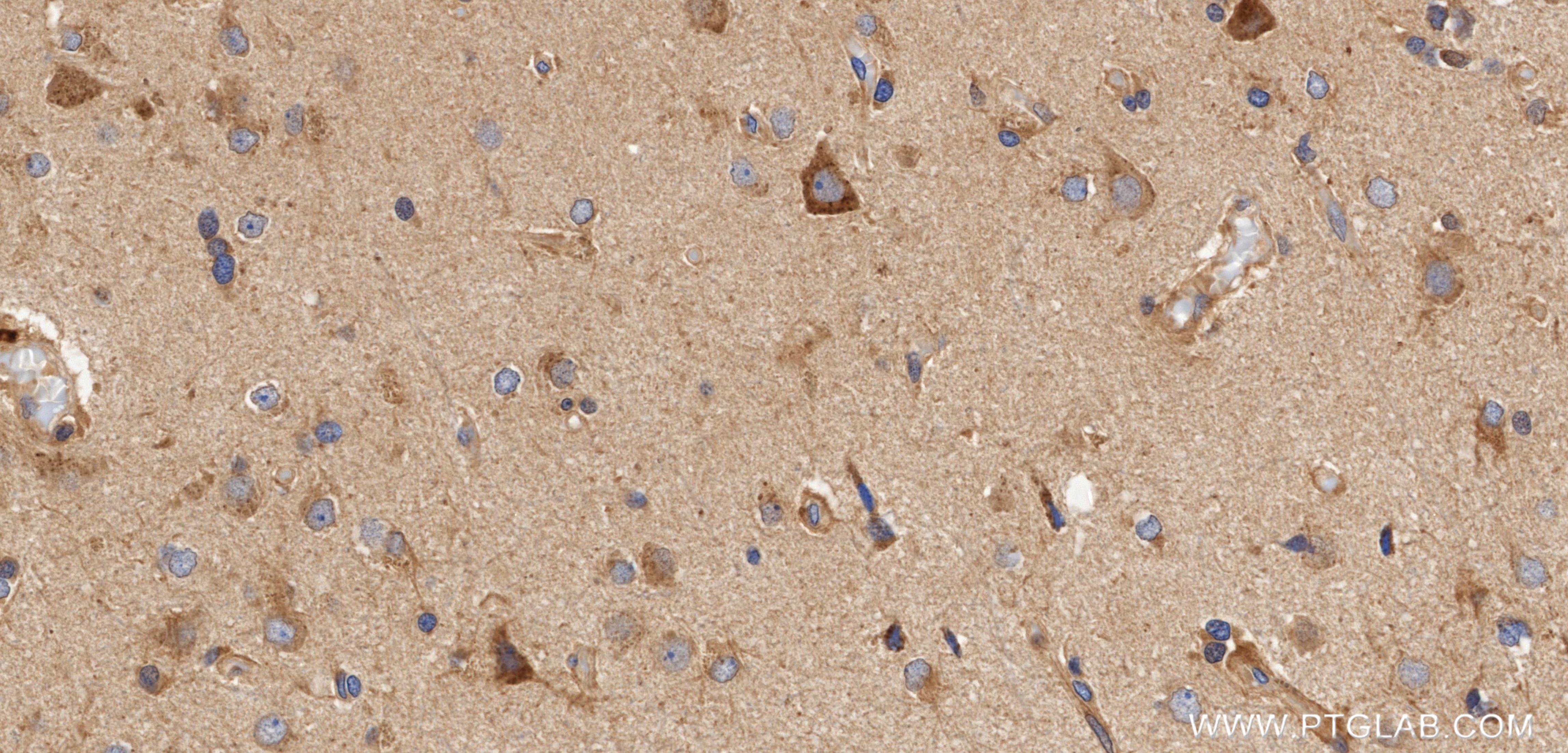 IHC staining of Human brain cancer（Astrocitoma） using 98696-1-RR (same clone as 98696-1-PBS)