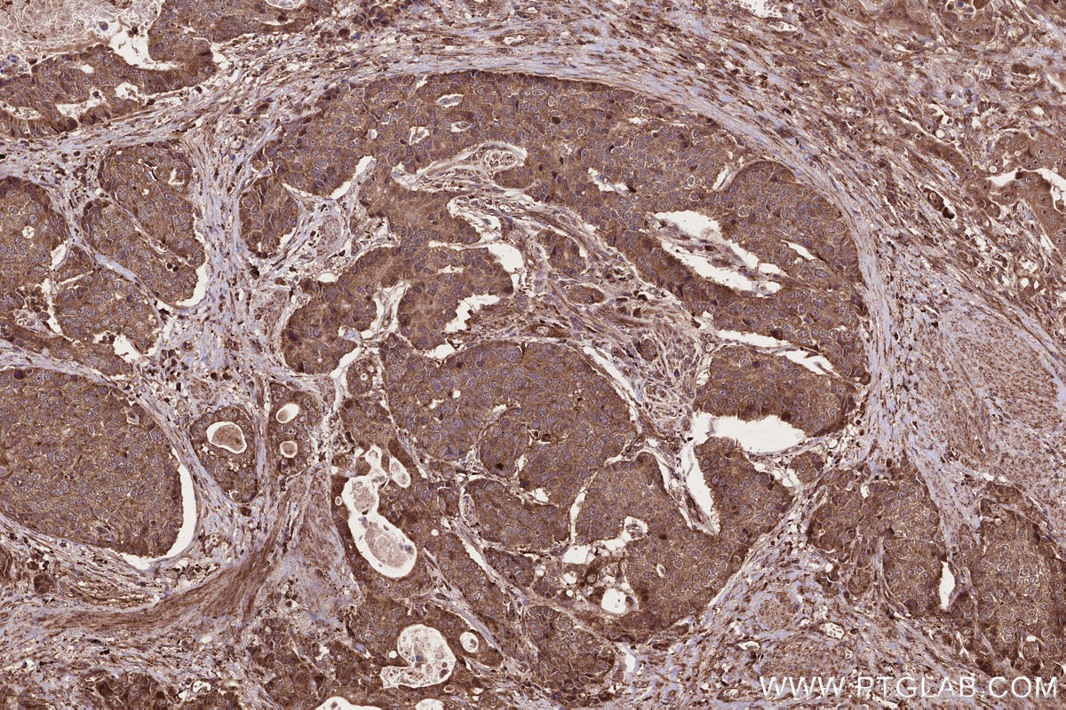 IHC staining of human stomach cancer using 55197-1-AP