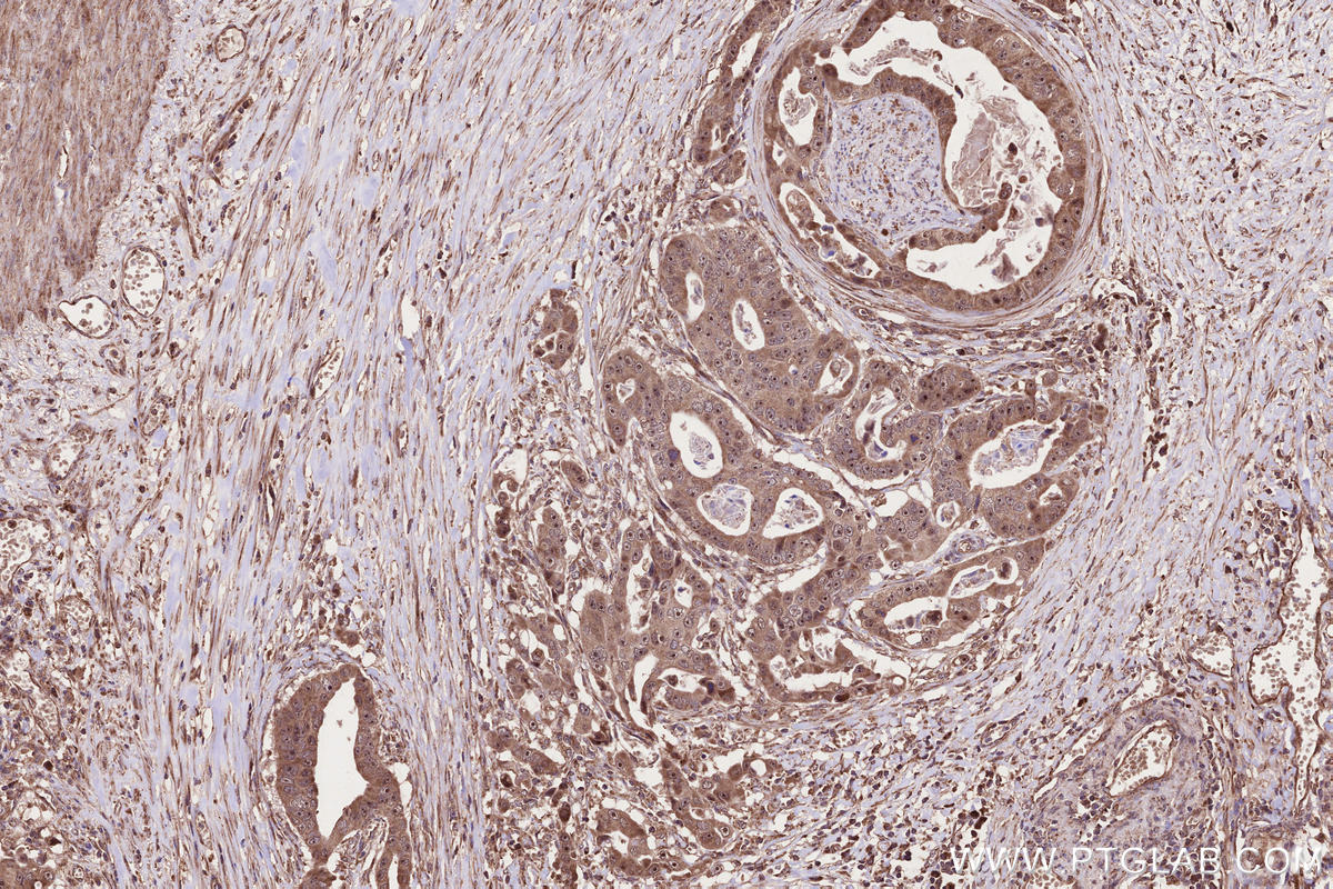 IHC staining of human stomach cancer using 55197-1-AP
