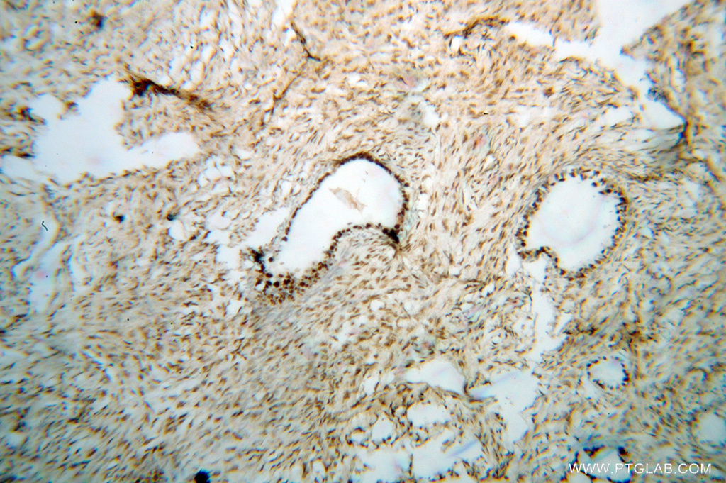 IHC staining of human ovary tumor using 14708-1-AP