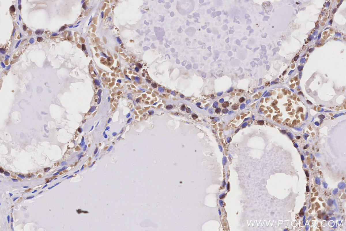 IHC staining of human thyroid cancer using 15978-1-AP IHC staining of human thyroid cancer using 15978-1-AP