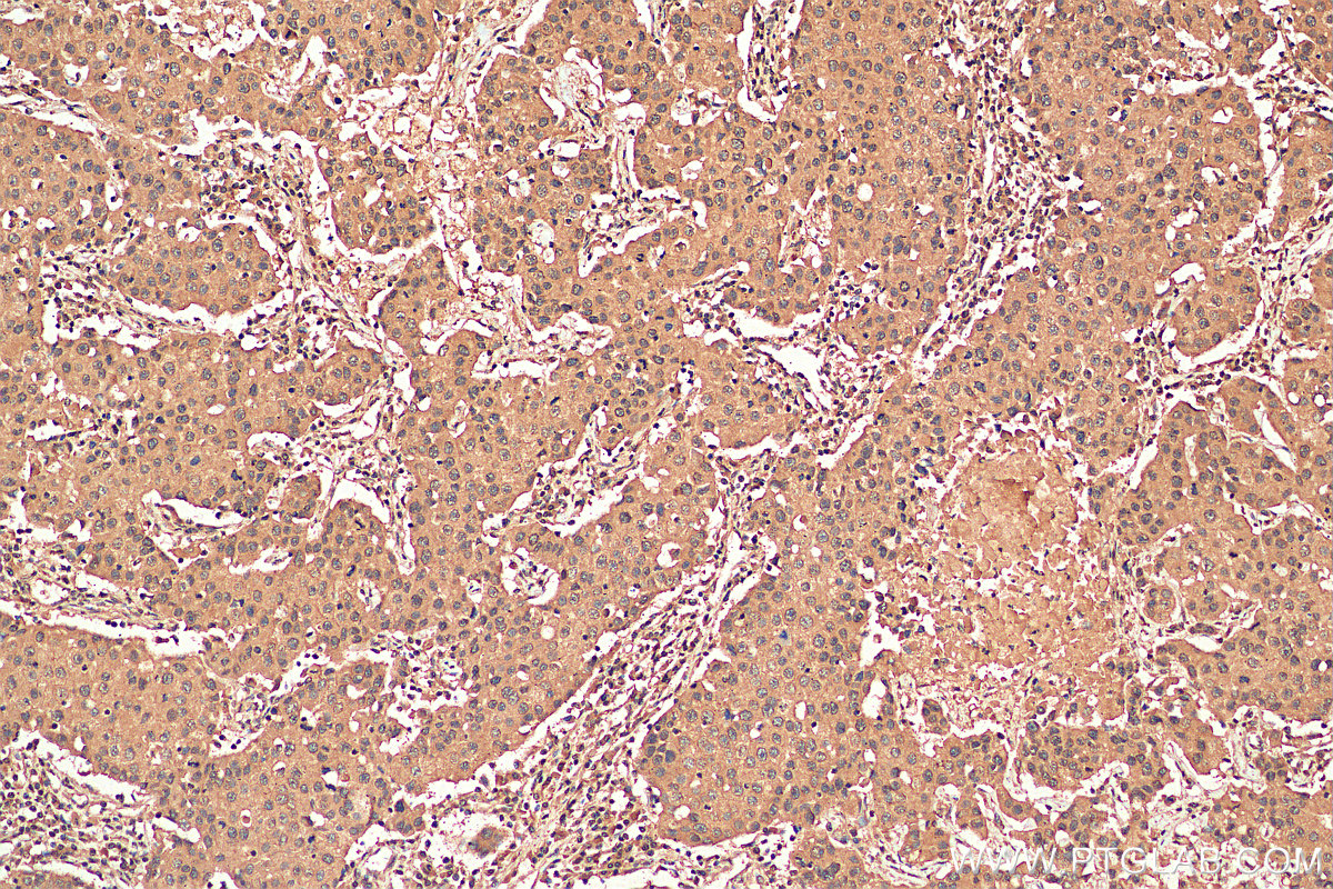 IHC staining of human breast cancer using 67946-1-Ig