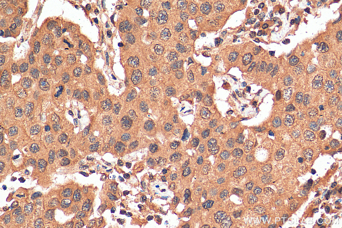 IHC staining of human breast cancer using 67946-1-Ig