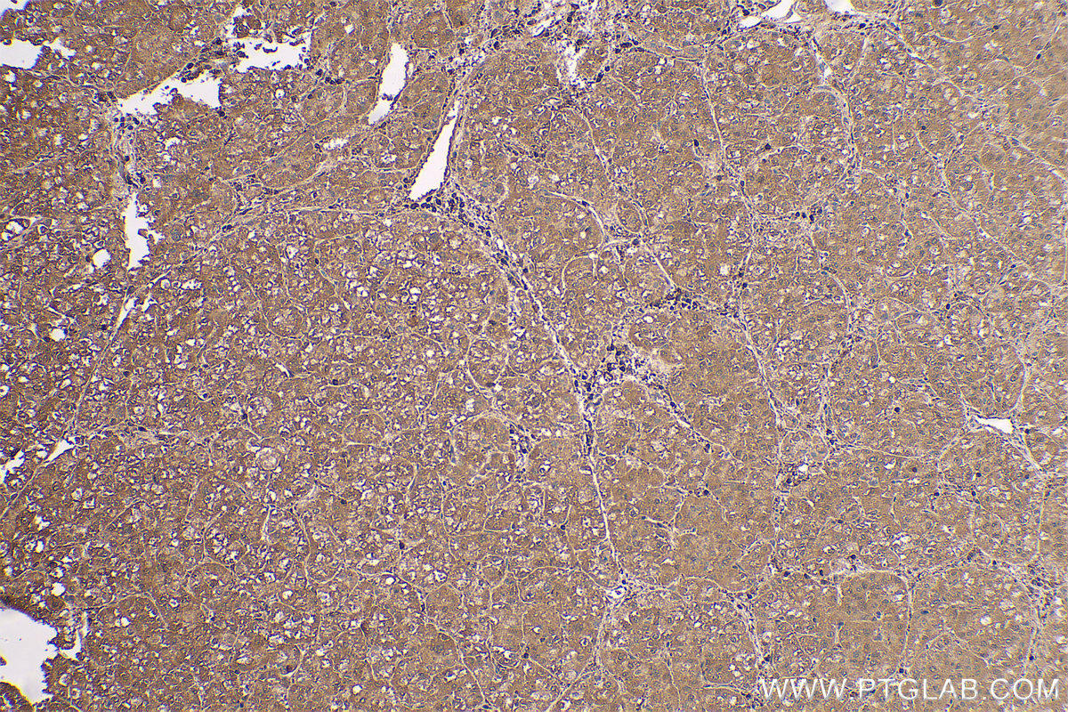 IHC staining of human liver cancer using 11681-1-AP