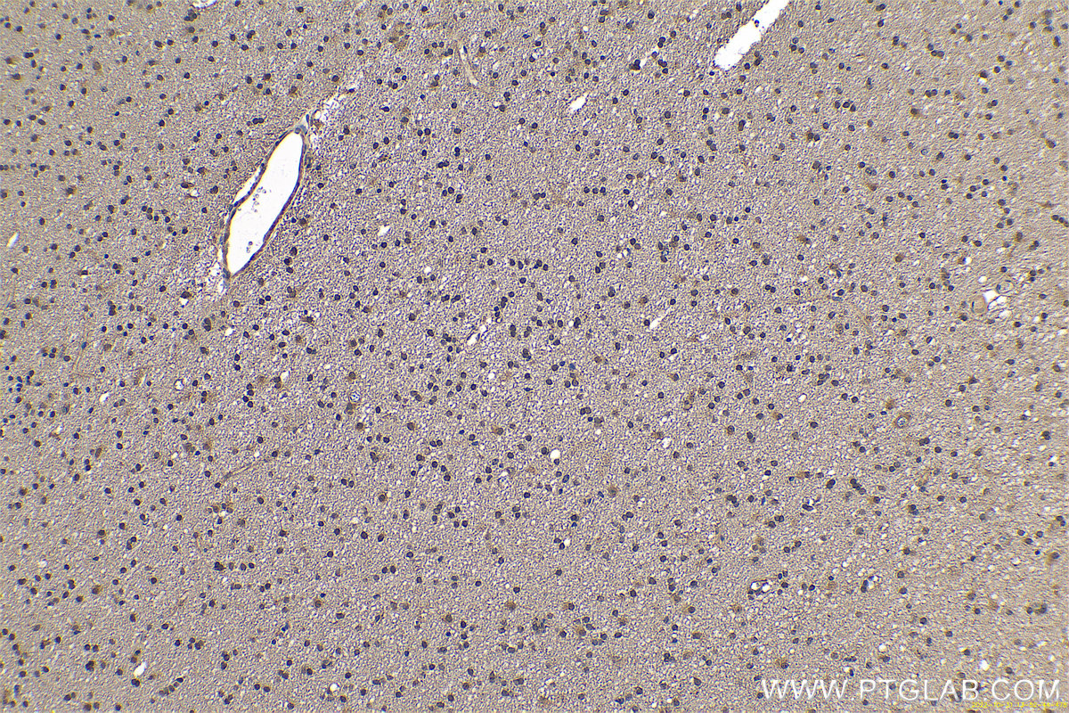 IHC staining of human gliomas using 11681-1-AP