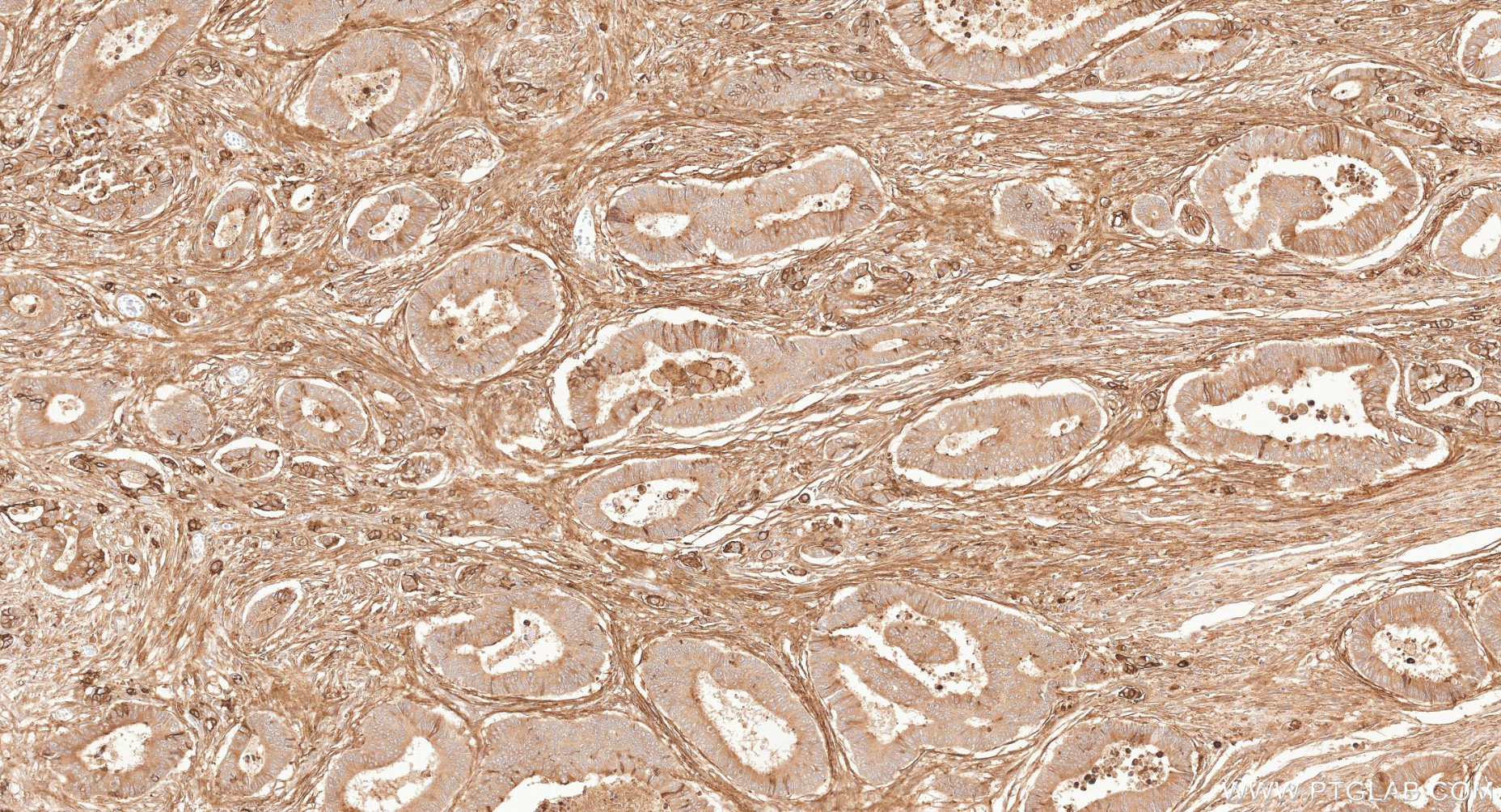 IHC staining of human colon cancer using 87241-3-RR IHC staining of human colon cancer using 87241-3-RR
