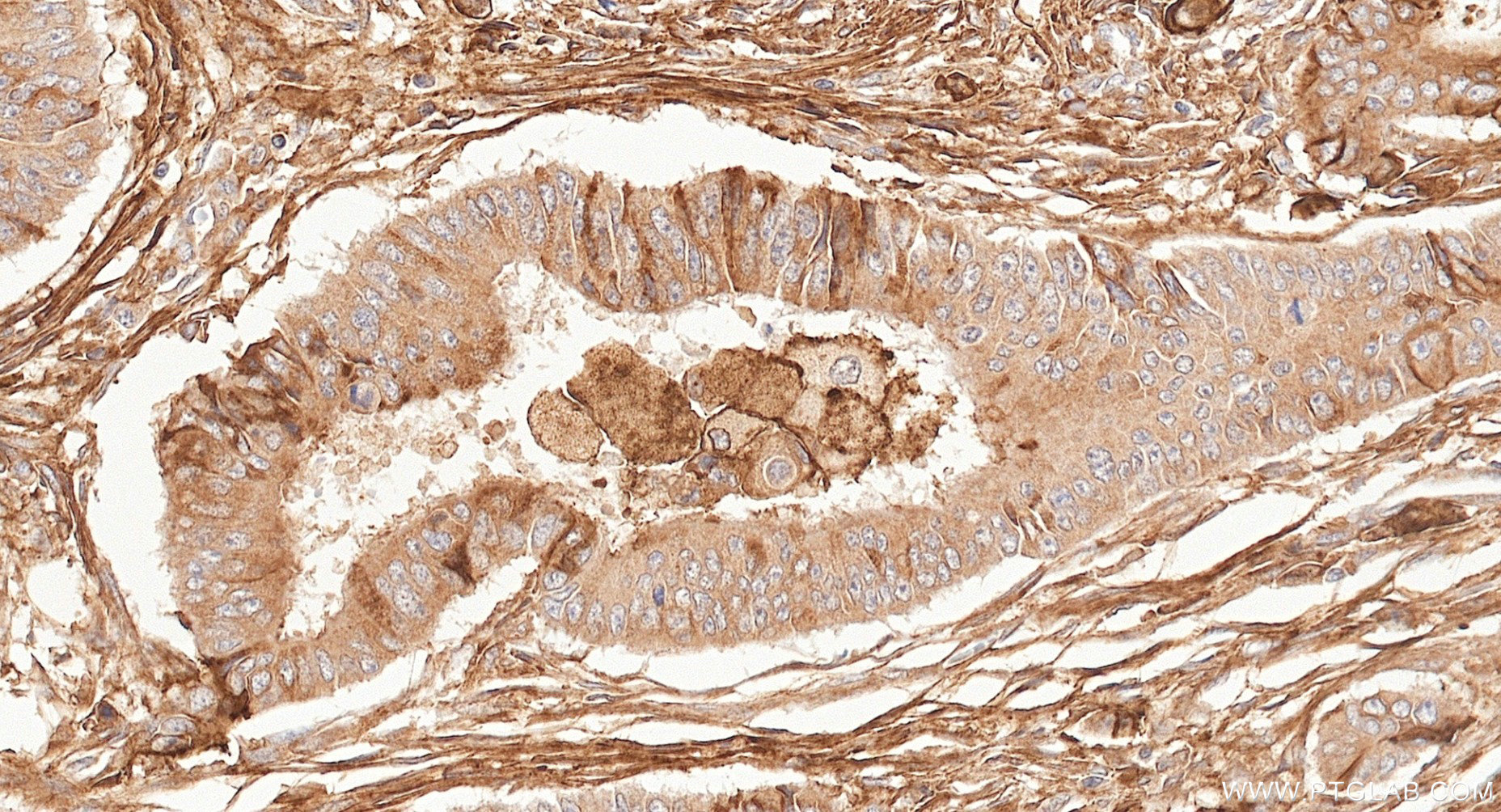 IHC staining of human colon cancer using 87241-3-RR IHC staining of human colon cancer using 87241-3-RR