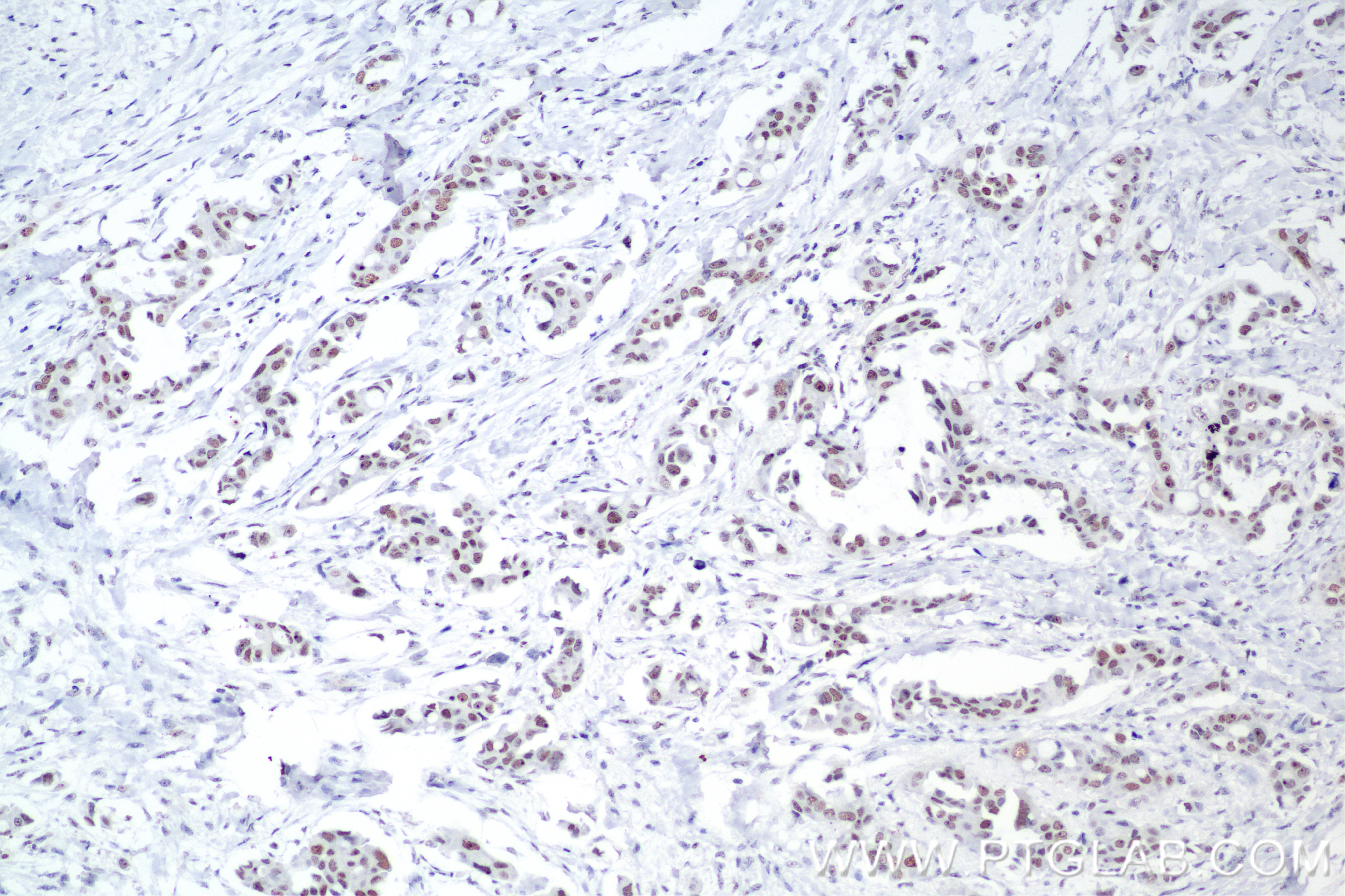 Immunohistochemical analysis of paraffin-embedded Human Breast Cancer(Her2+;ER-;PR-) slide using 85408-5-RR (PARN antibody) at dilution of 1:1000 (under 10x lens). Heat mediated antigen retrieval with Tris-EDTA buffer (pH 9.0). IHC staining of Human Breast Cancer(Her2+;ER-;PR-) using 85408-5-RR