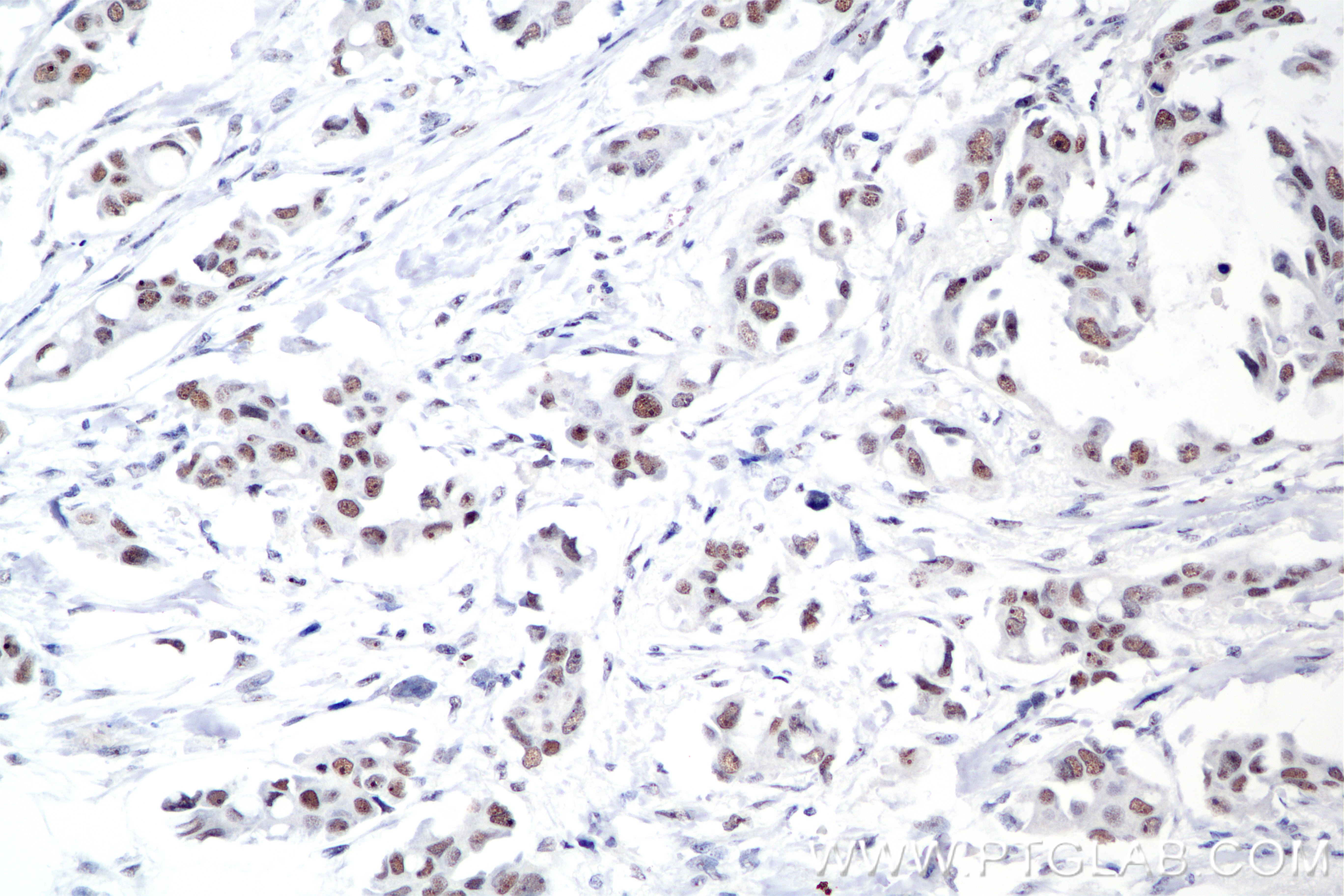 Immunohistochemical analysis of paraffin-embedded Human Breast Cancer(Her2+;ER-;PR-) slide using 85408-5-RR (PARN antibody) at dilution of 1:1000 (under 20x lens). Heat mediated antigen retrieval with Tris-EDTA buffer (pH 9.0). IHC staining of Human Breast Cancer(Her2+;ER-;PR-) using 85408-5-RR
