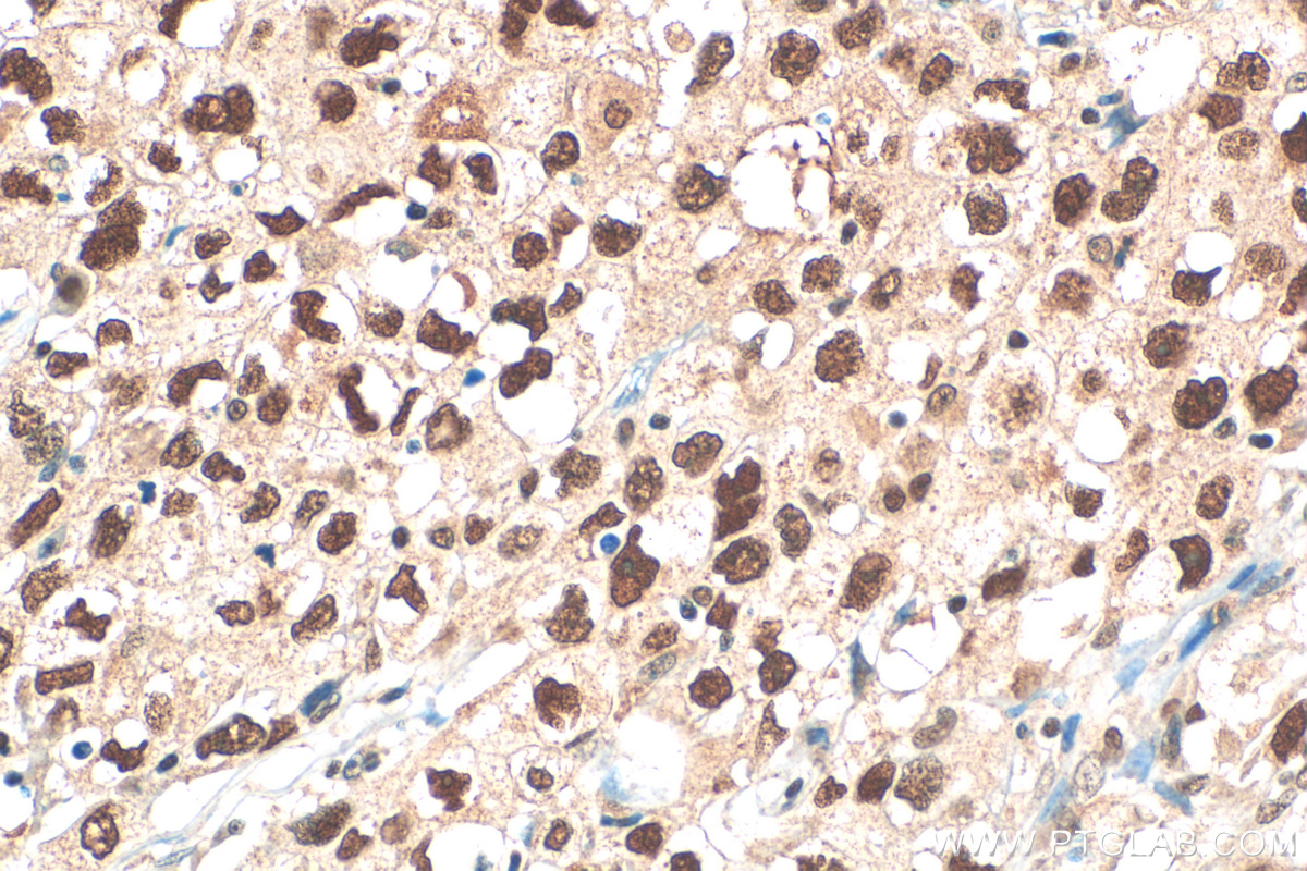 IHC staining of human lung cancer using 13371-1-AP