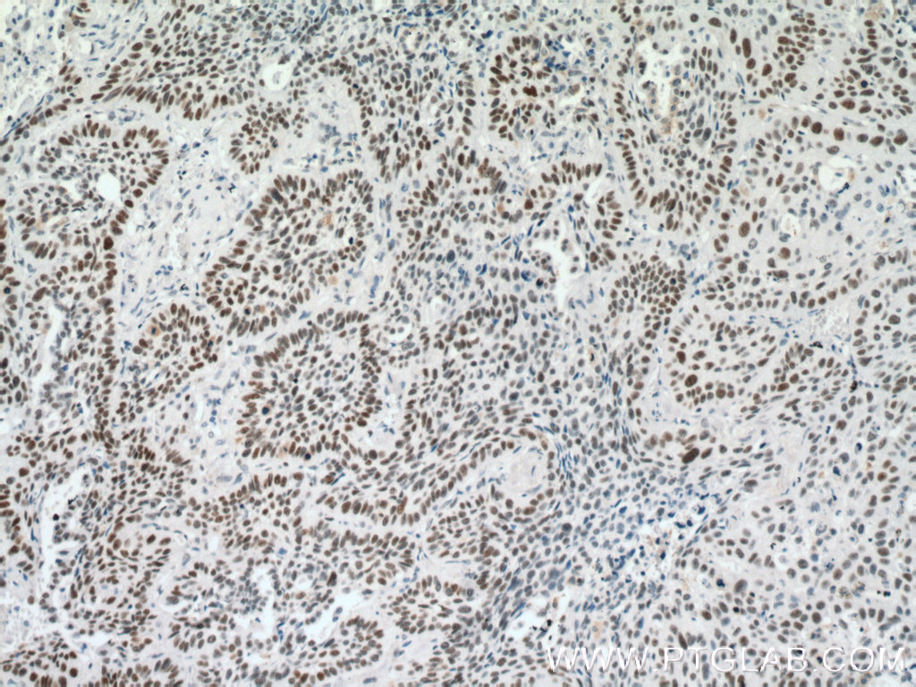 IHC staining of human lung cancer using 66520-1-Ig