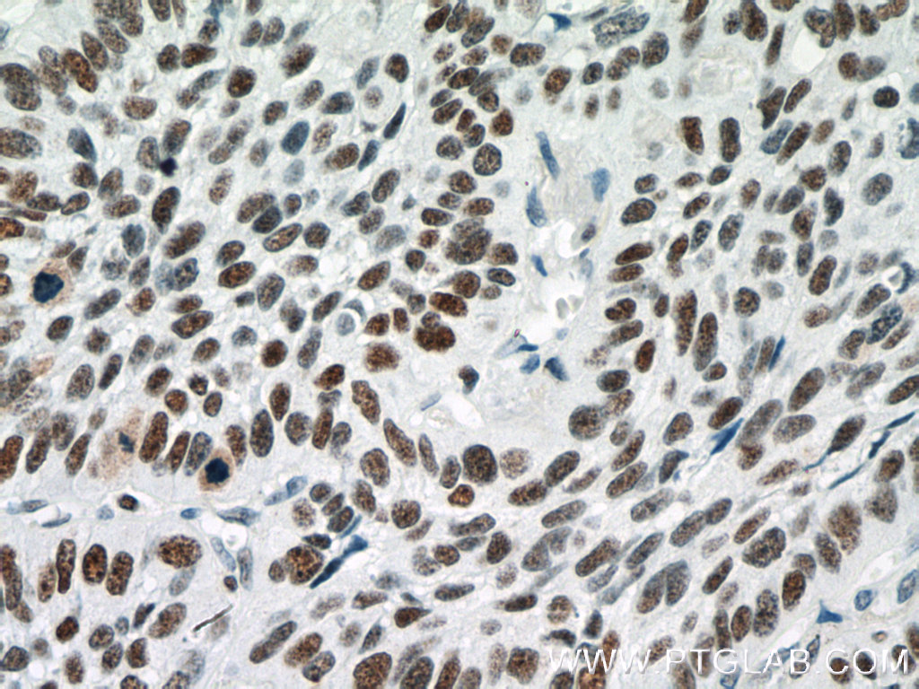 IHC staining of human lung cancer using 66520-1-Ig