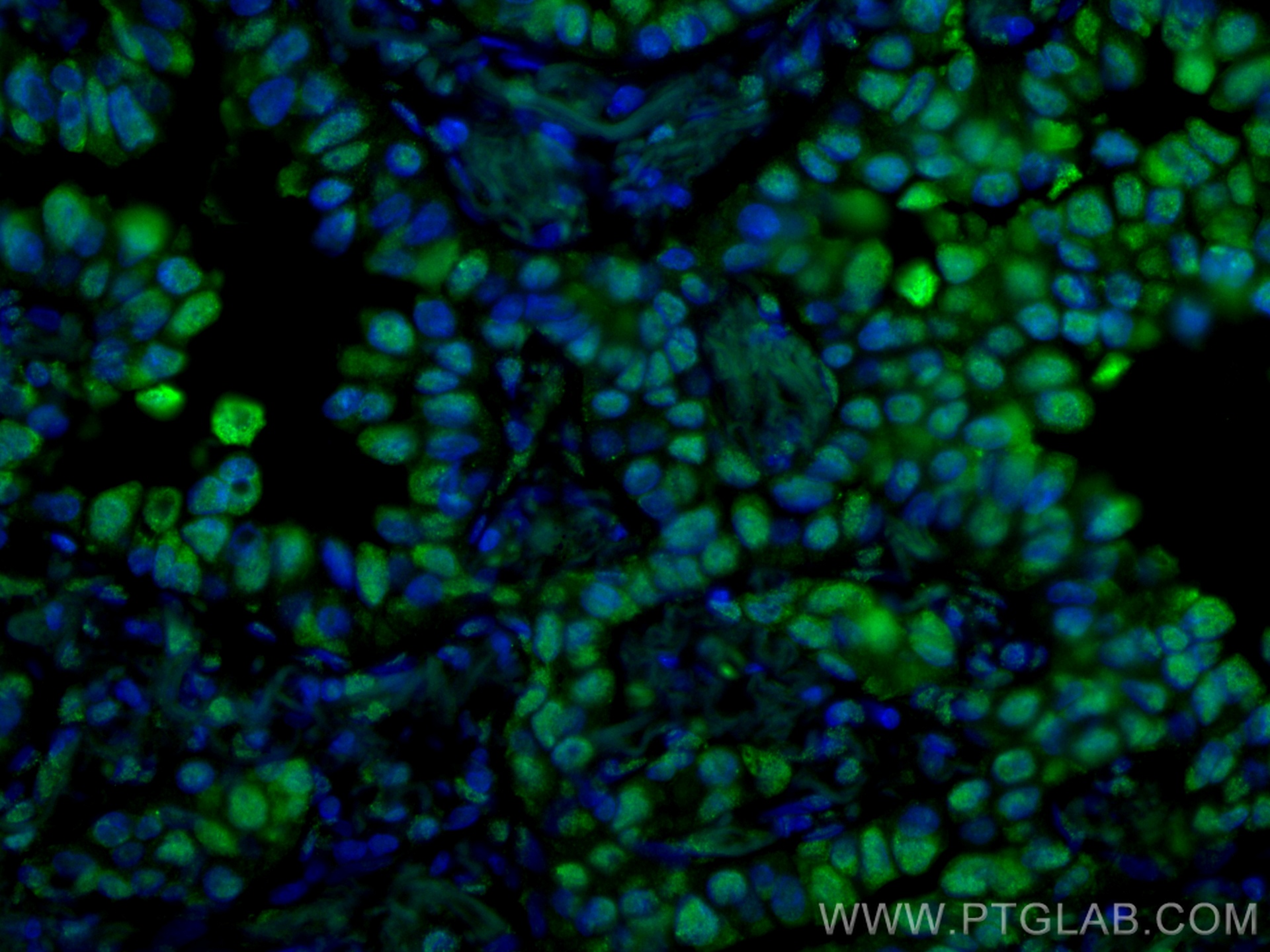IF Staining of human lung cancer using CL488-66520