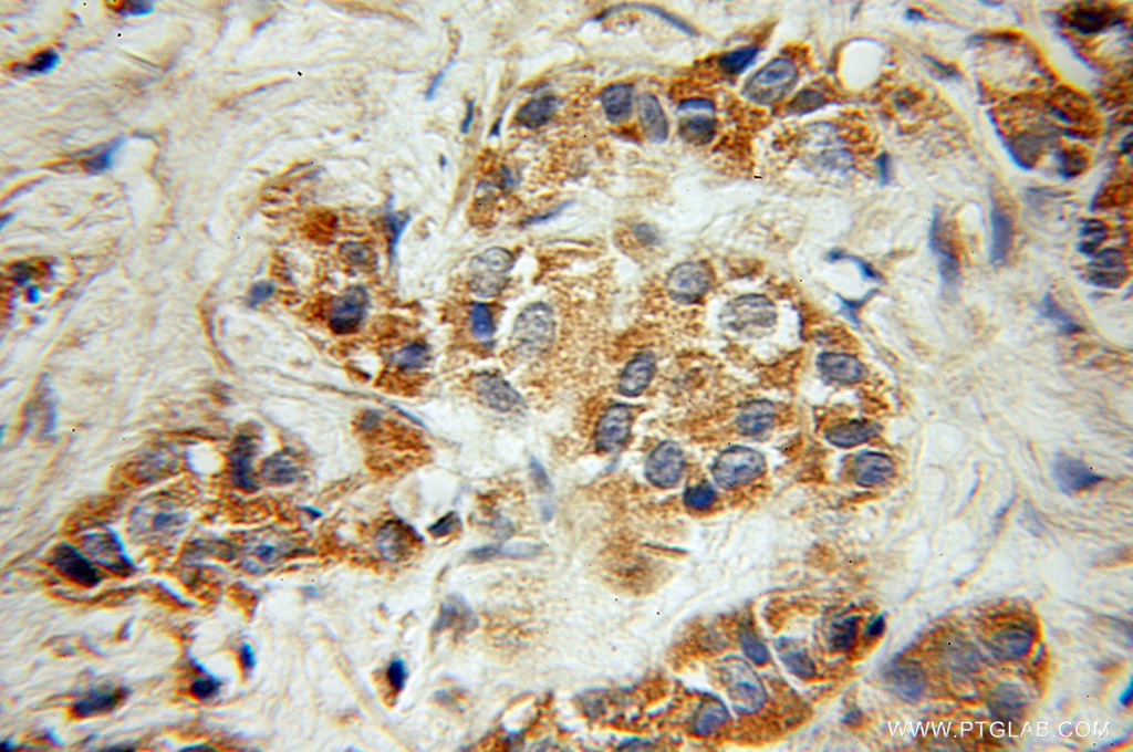 IHC staining of human prostate cancer using 11202-1-AP