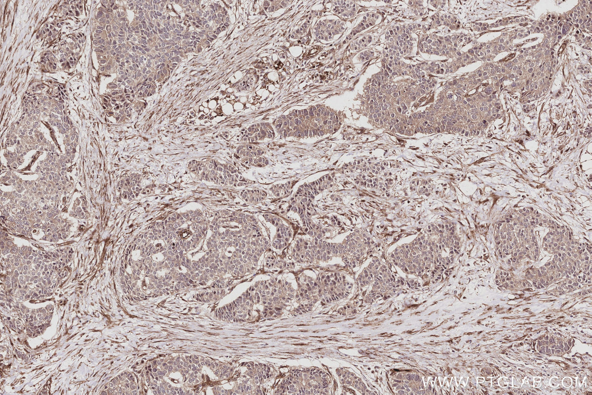IHC staining of human stomach cancer using 85711-1-RR