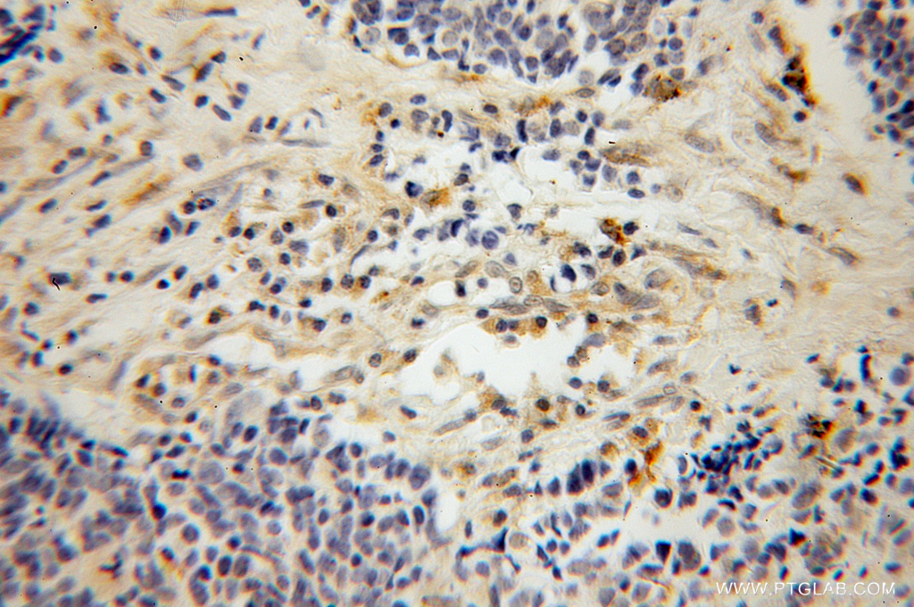 IHC staining of human lung cancer using 13284-1-AP