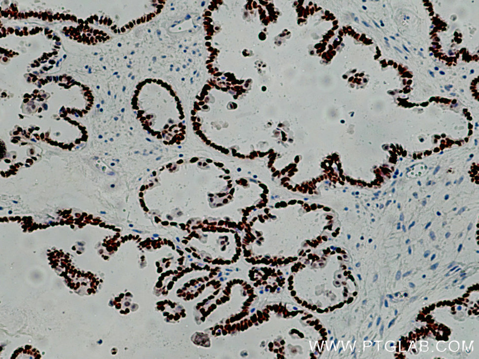 IHC staining of human ovary tumor using 60145-4-Ig