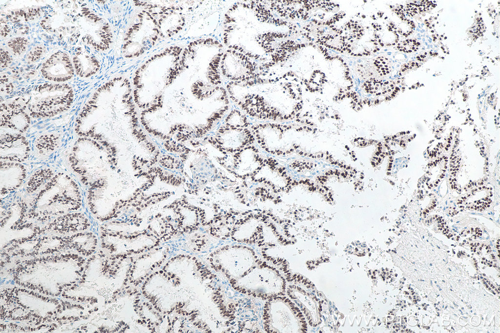 IHC staining of human ovary tumor using 60145-4-Ig