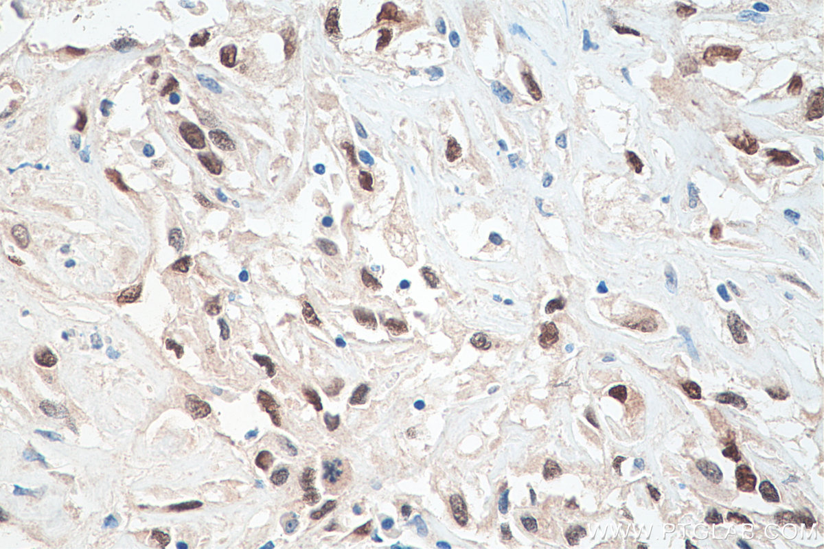 IHC staining of human renal cell carcinoma using 60145-4-Ig