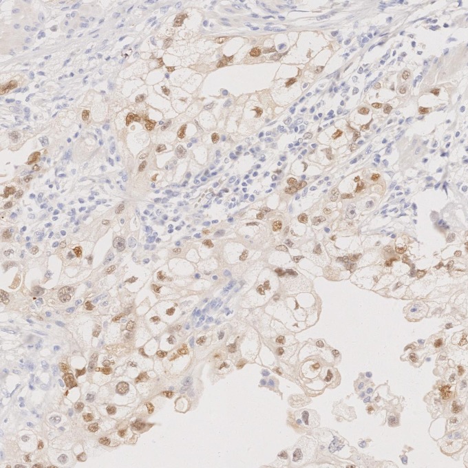 IHC staining of human ovary cancer using 60145-4-Ig