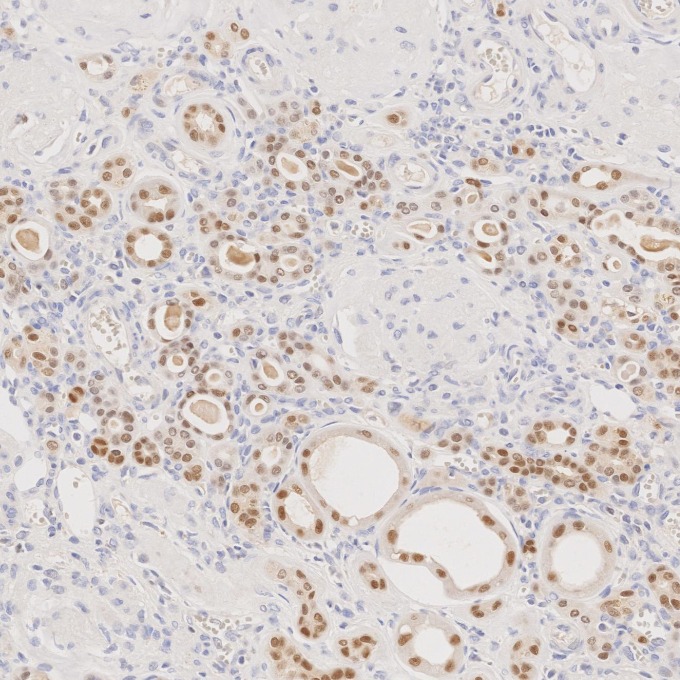 IHC staining of human renal cell carcinoma using 60145-4-Ig